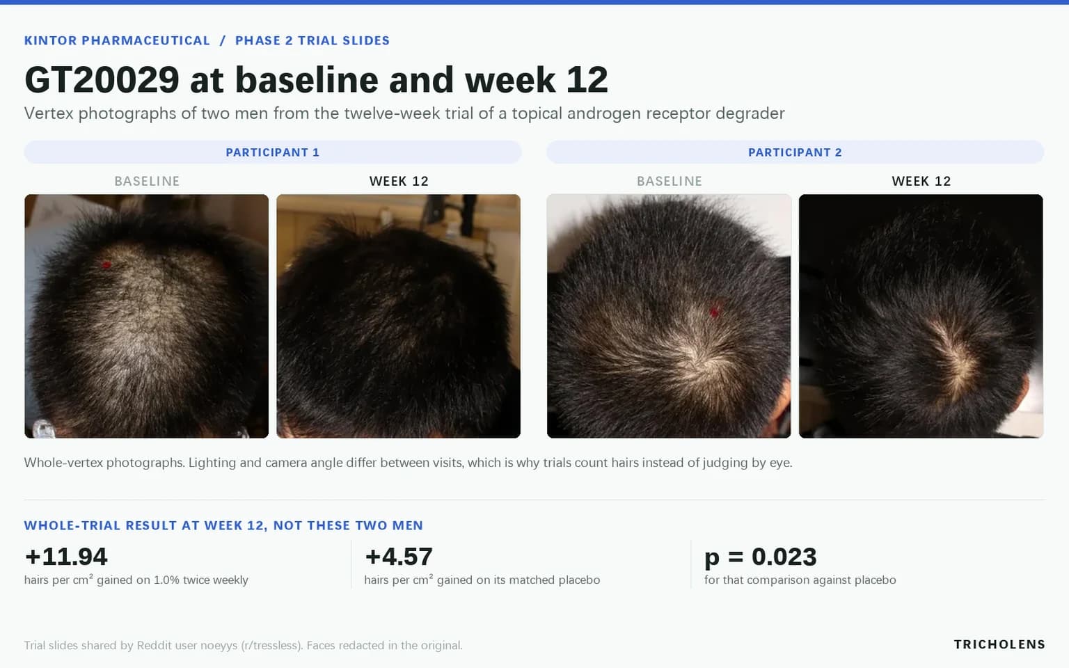 Four scalp photographs side by side showing two GT20029 trial participants at baseline and at week 12